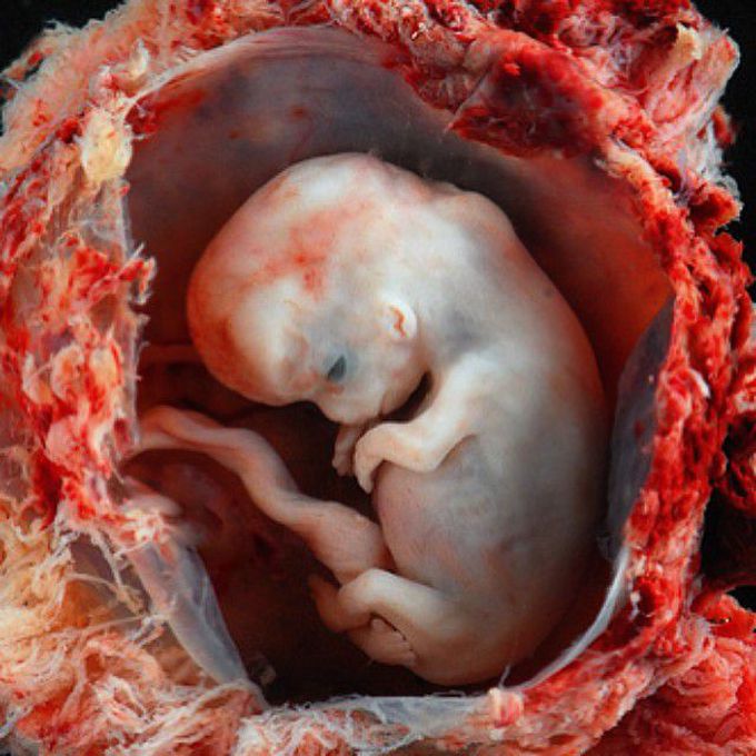 Abortion