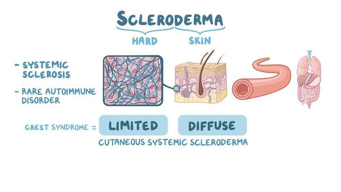 Scleroderma