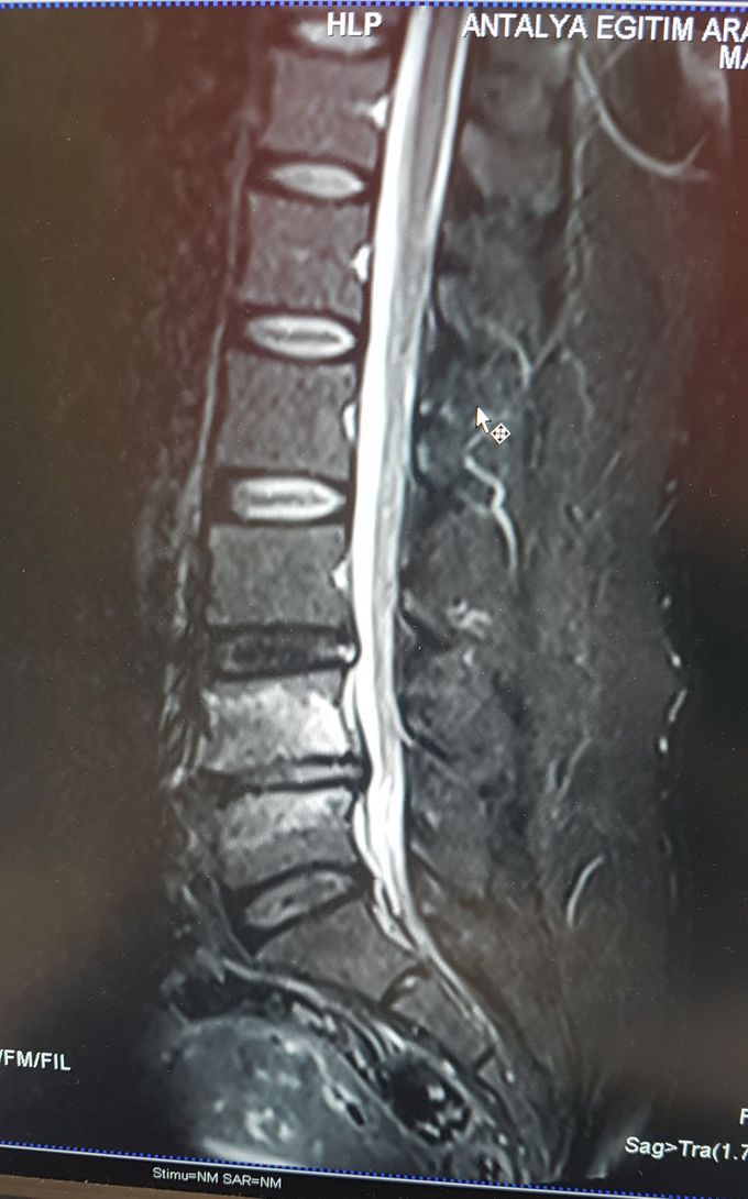 Radiculopathy? Lumbar Magnetic Resonance Image