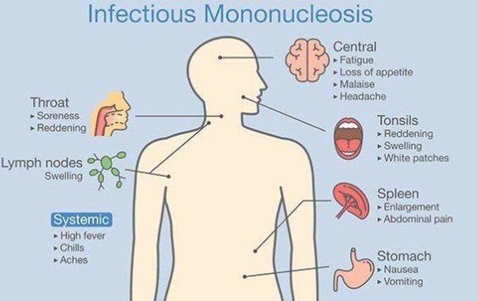 Mononucleosis