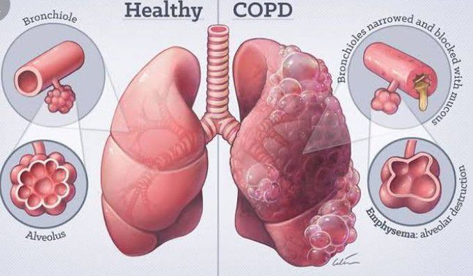 Chronic obstructive pulmonary disease (COPD)