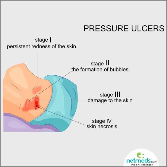 Pressure Sore Grades MEDizzy