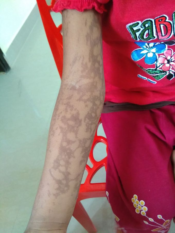 8 yr old female child has black discoloration on both the upper limbs and abdomen from birth. What is the diagnosis ???
