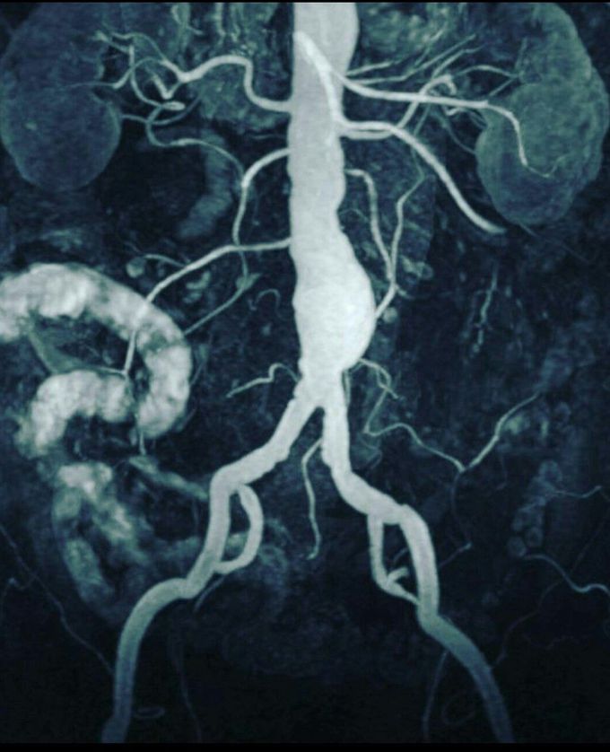 Abdominal aortic aneurysm