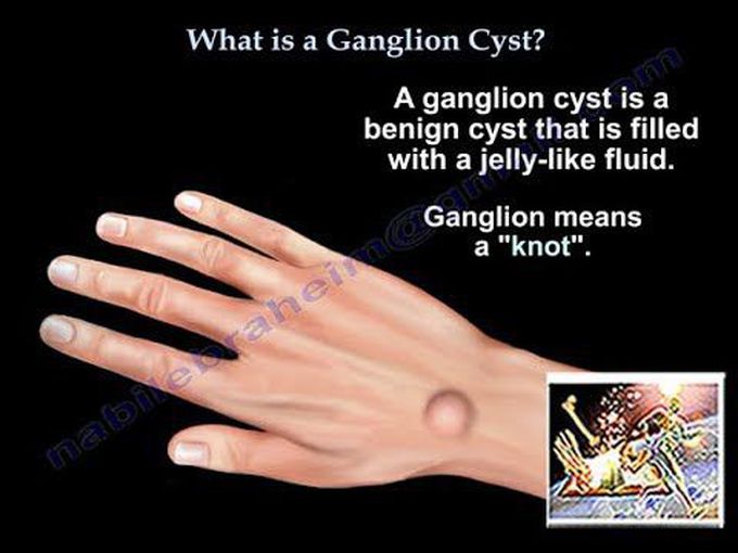 Ganglion Cyst-Animation