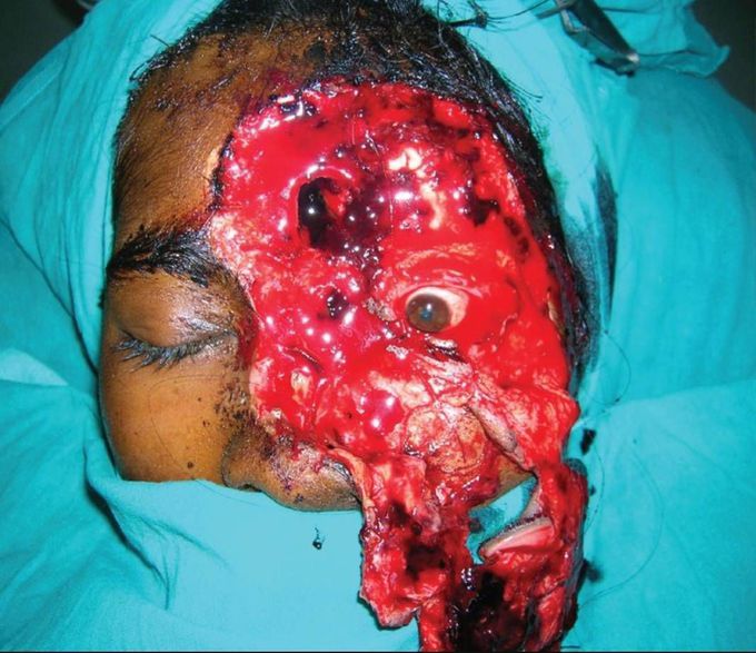 Post-assault degloving of the nose, part of forehead with anterior wall of frontal sinus, entire upper and lower eyelids and the cheek - part 1