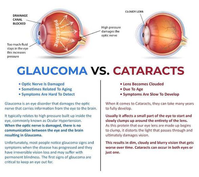 Glaucoma vs cataract