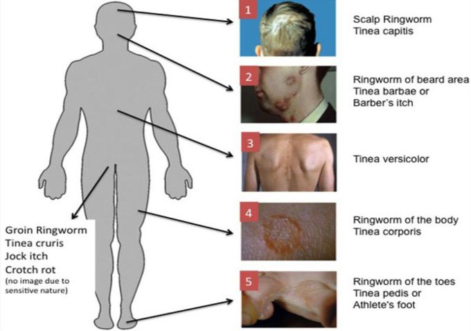 Common Fungal Infections