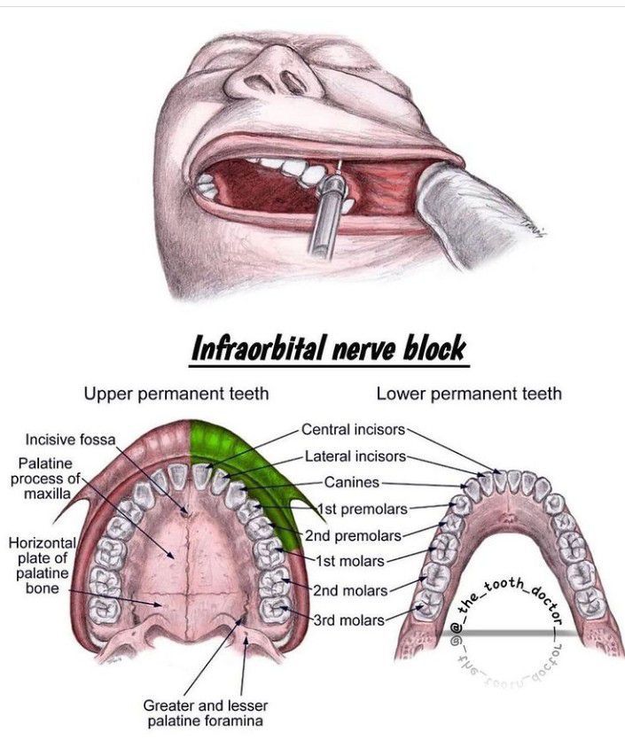 infraorbital nerve