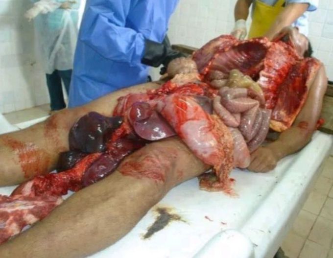 Postmortem