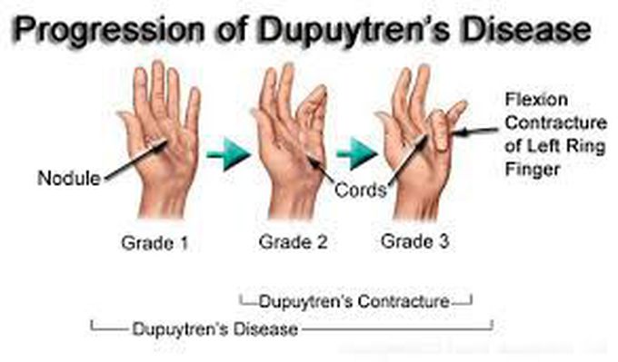 Progression of Dupuytren's contracture