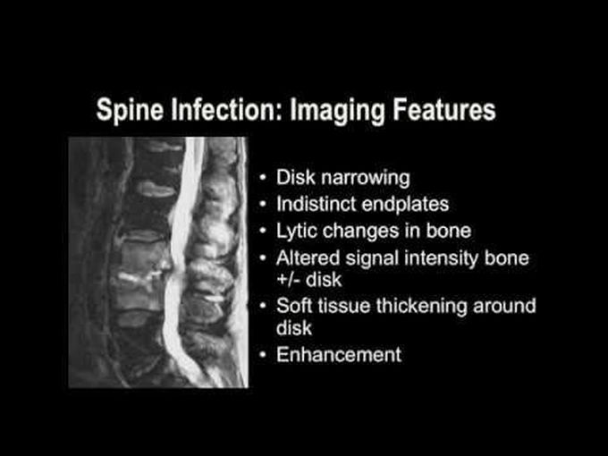 Interpretation of MRI Spine and Common Disorders