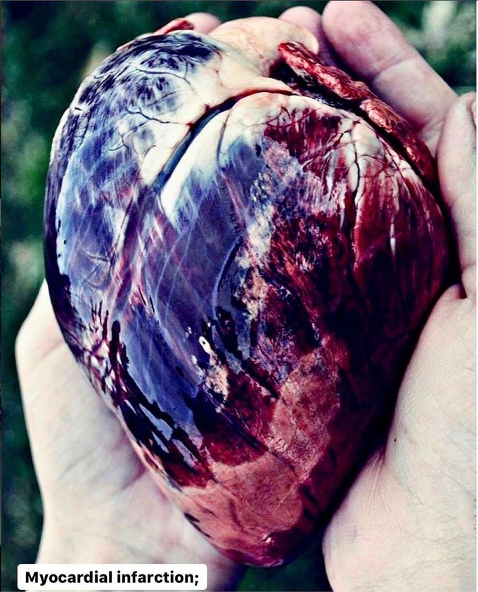 Myocardial infarction