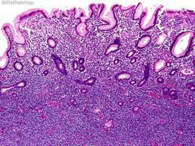 MALT lymphoma (MALToma)