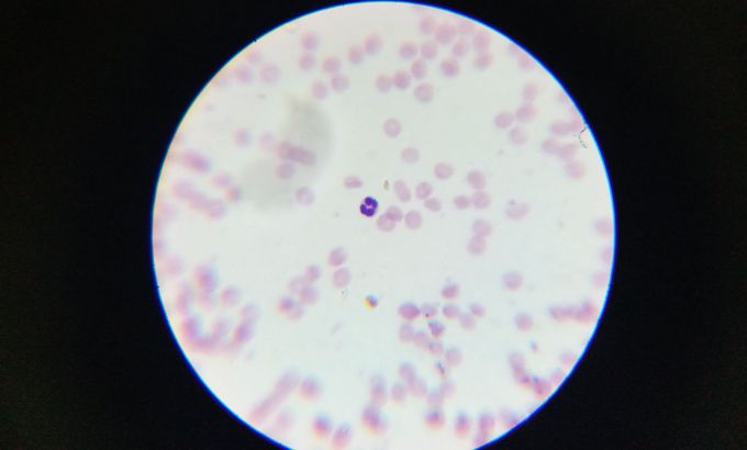 Eosinophile in whole blood smear