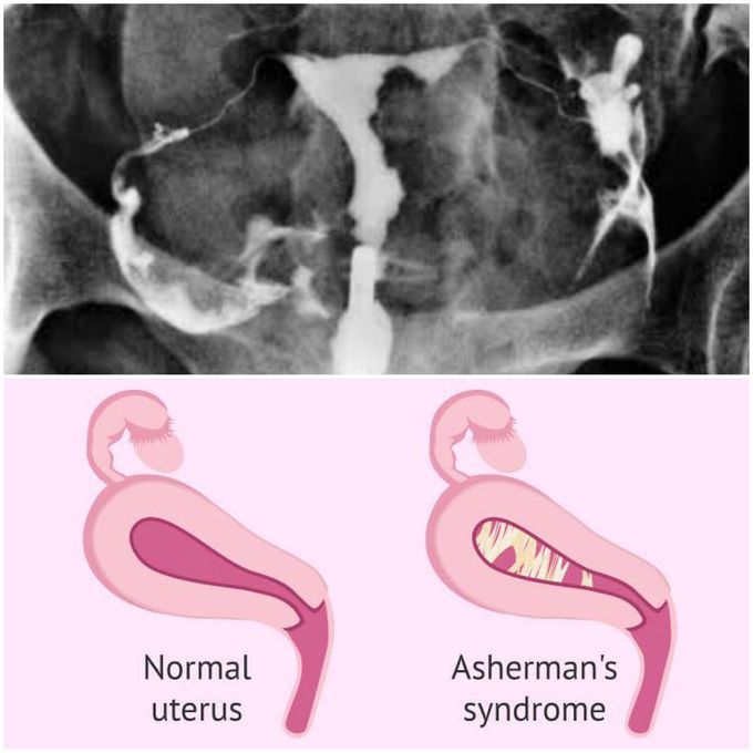 Asherman syndrome (intrauterine synechiae)