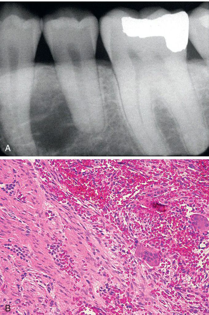 Odontogenic Fibroma (WHO Type) with Associated Giant Cell Granuloma.