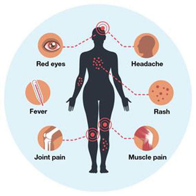 Zika Virus Infection