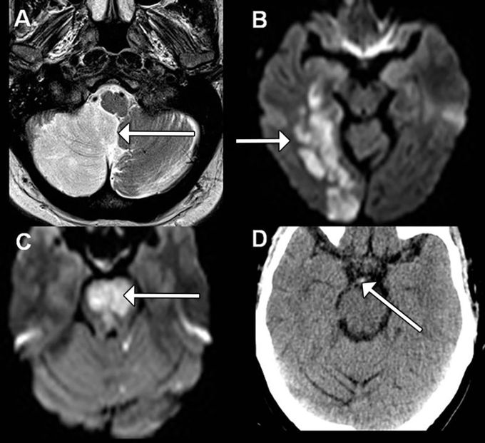 5 Ds of Posterior Stroke