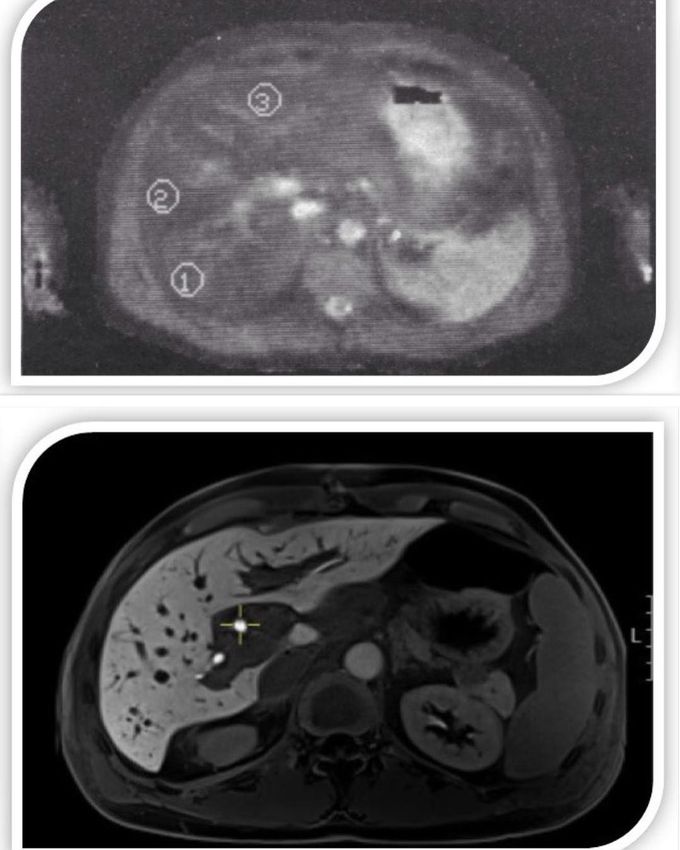 Early liver MRI scan from the 1986