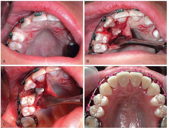 impacted maxillary canine