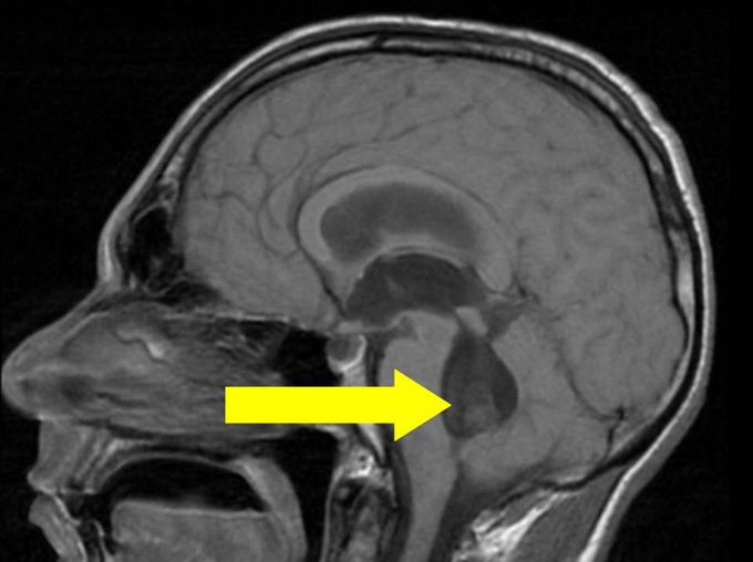 Bruns Syndrome