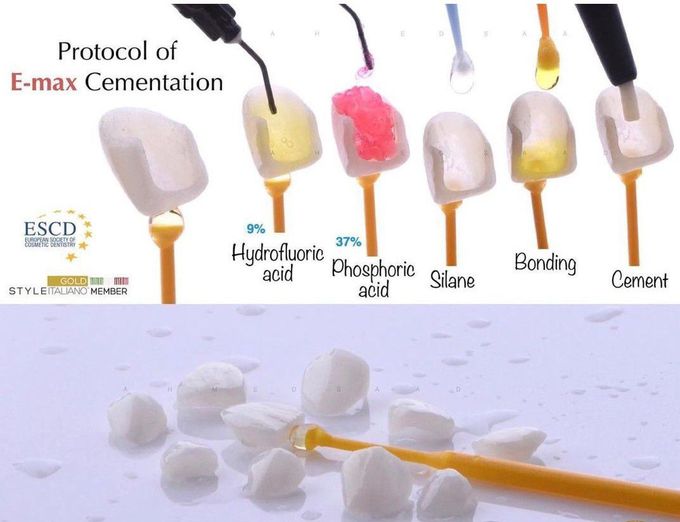 Protocol of Emax Cementation