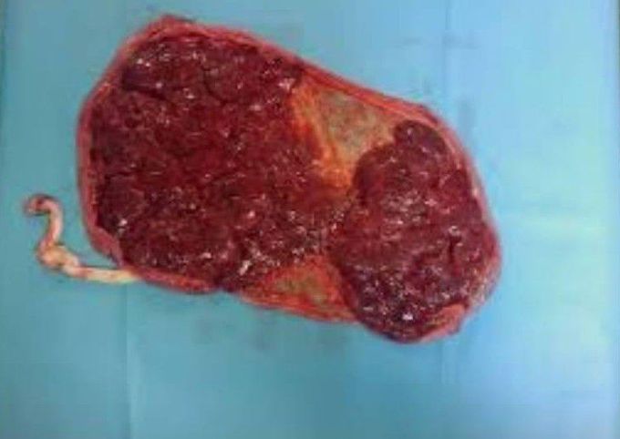 Can you name the placental abnormality?