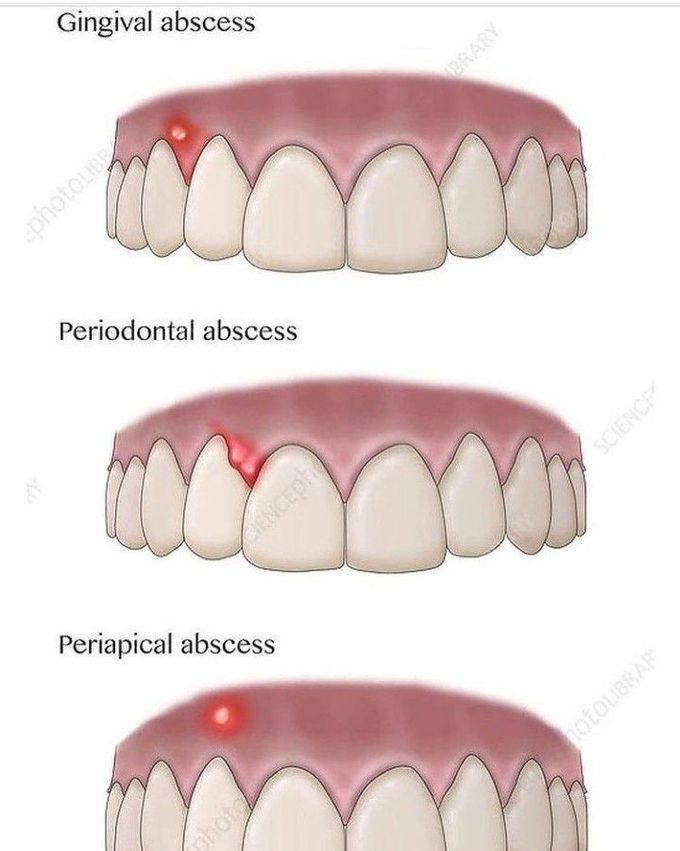 Dental Abscess