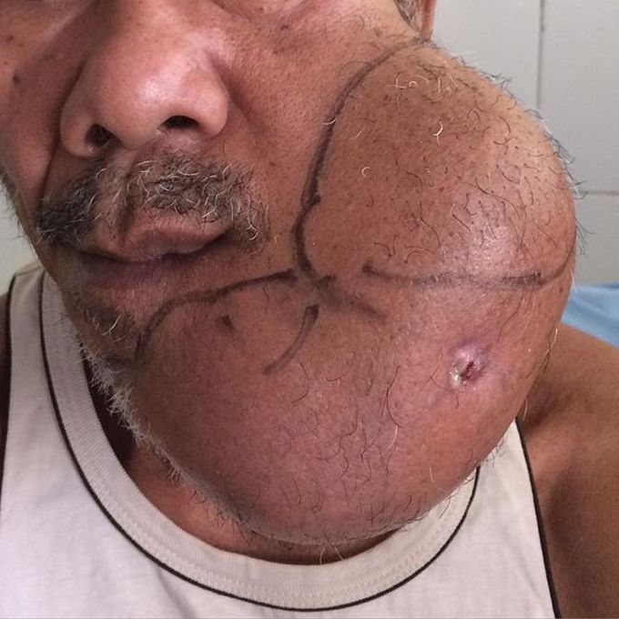 Ameloblastoma