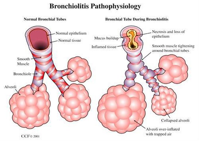 What Causes Acute Bronchitis In Babies