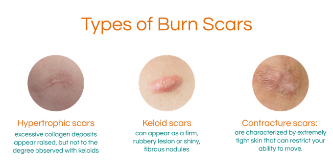 Types of burn scars