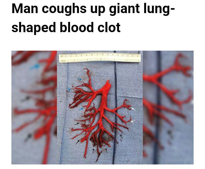 A blood clot formed in the exact shape of a man's lung passage - then he  coughed it up