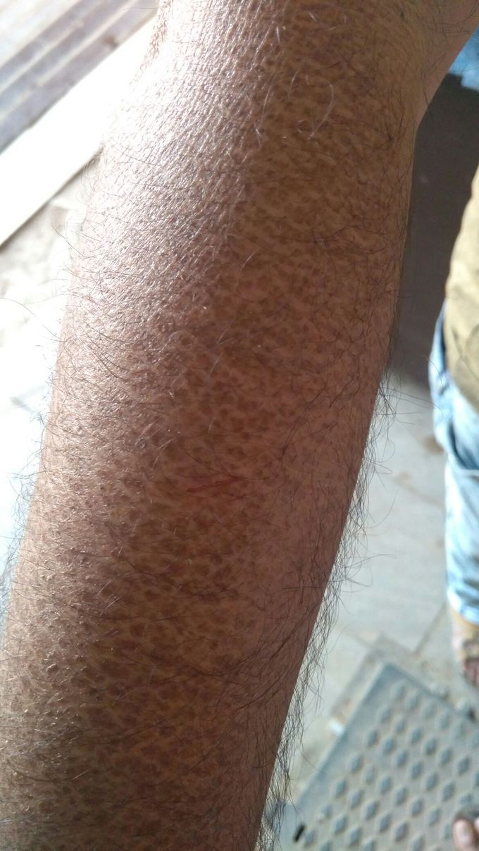 Skin conditions