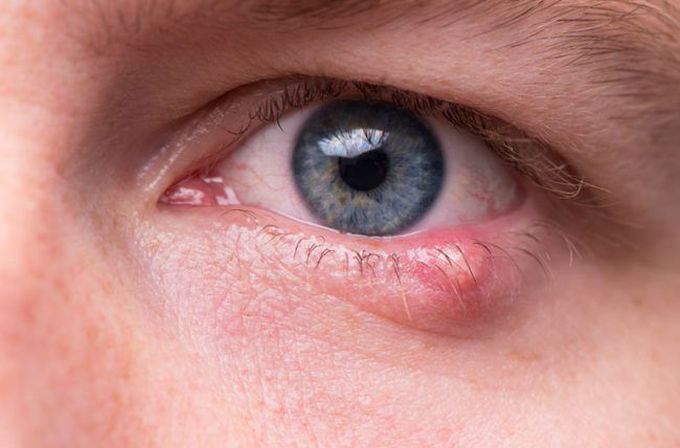 Stye infection