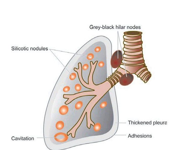 Silicosis