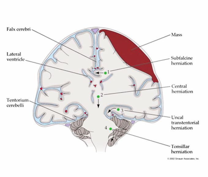 Brain herniation types (Green circles 1-4)