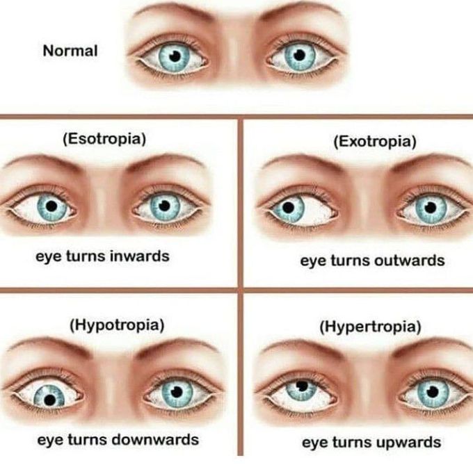 Conditions of eyes