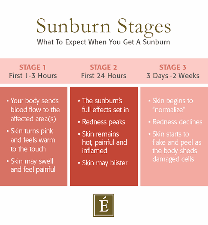 Sunburn Stages