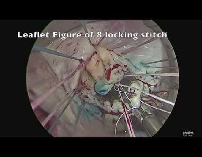 Minimally Invasive Mitral Valve Repair Using Adjustable Chord-X and Locking Figure-of-Eight