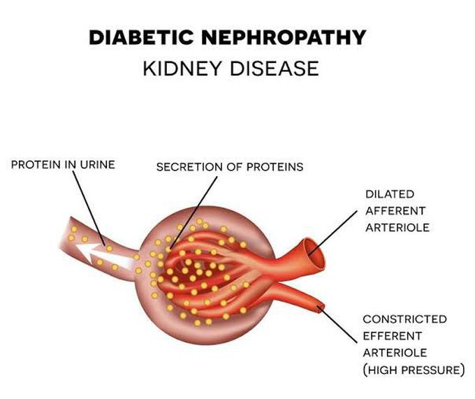 What is diabetic nephropathy