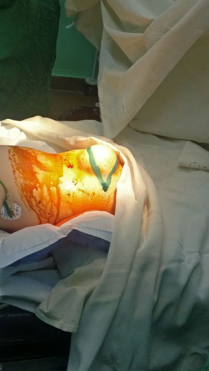 Spina bifida