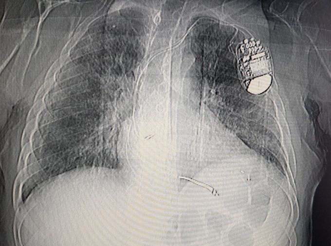 COVID-19 TORAX CT + PACEMAKER