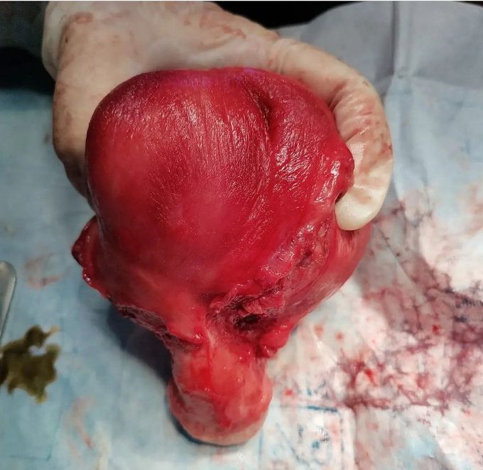 Uterine Fibroid