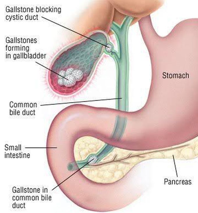 Biliary Colic