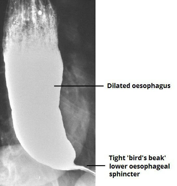 The characteristic feature of achalasia on barium swallow; a bird’s beak appearance caused by failure of relaxation of the lower oesophageal sphincter