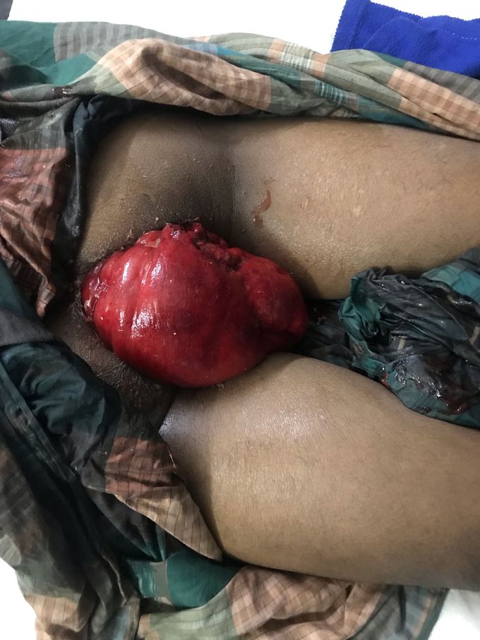 Rectal prolapse??