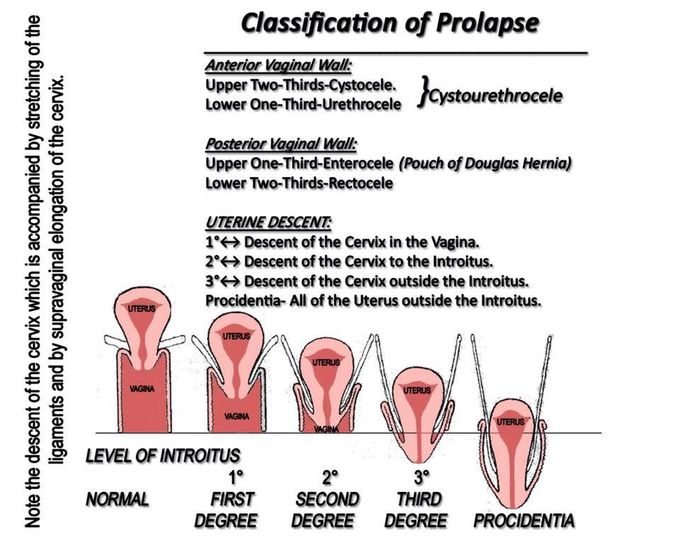 Degrees of Uterine Prolapse