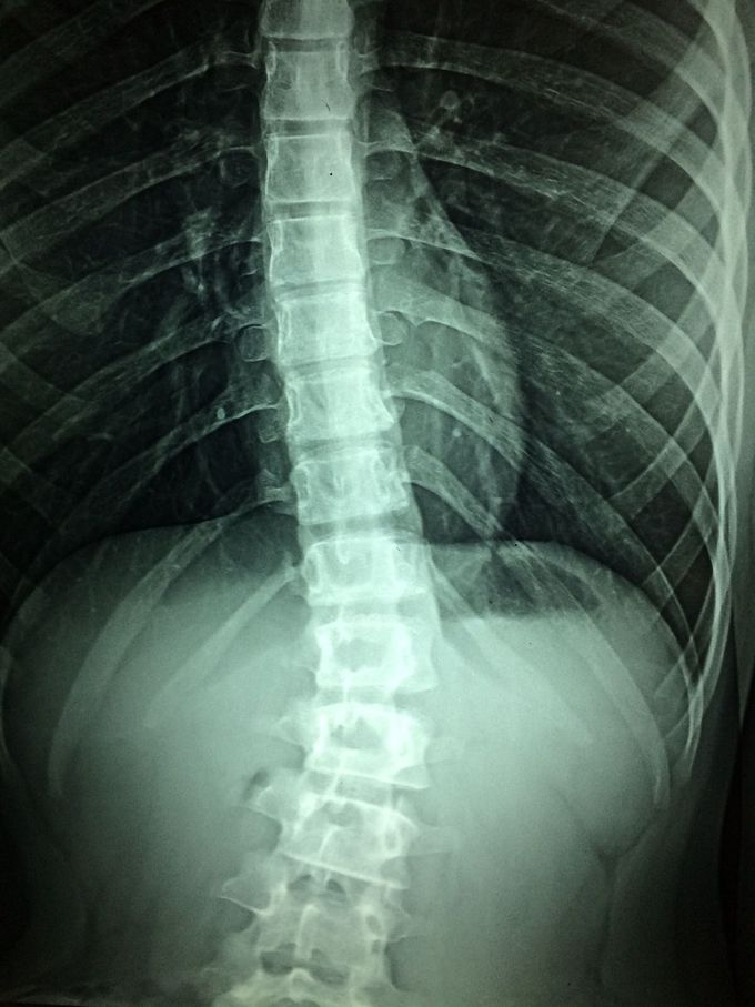 A recipe for regenerating nerve fibers across complete spinal cord injury
