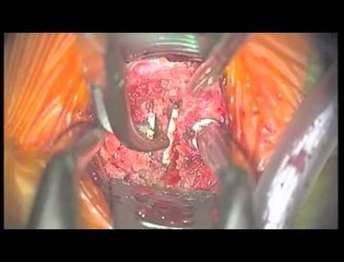 Surgical technique for revision surgery of cervical artificial disc replacements